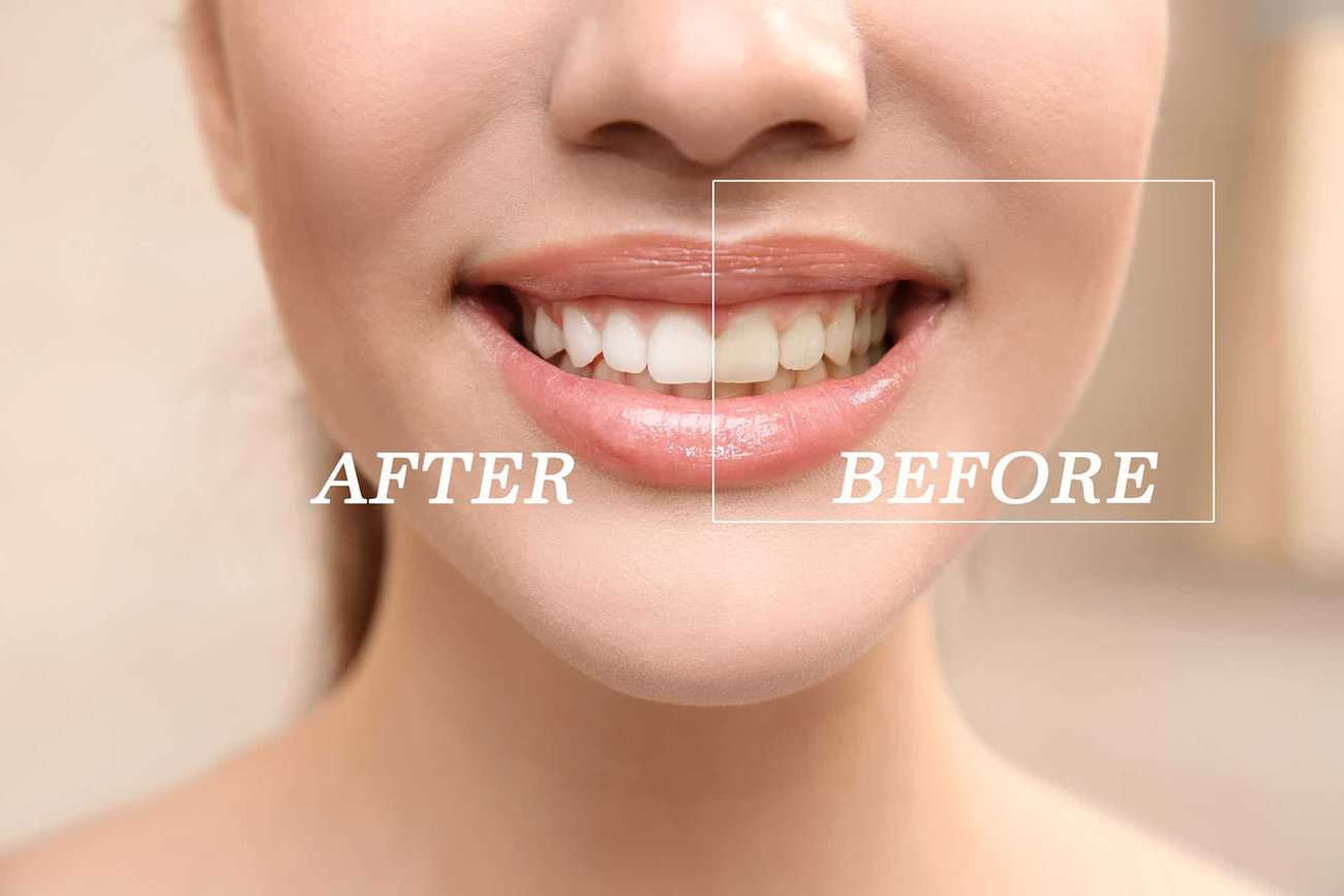 What Are the Most Effective Natural Teeth Whitening Methods You Can Try Crewe?