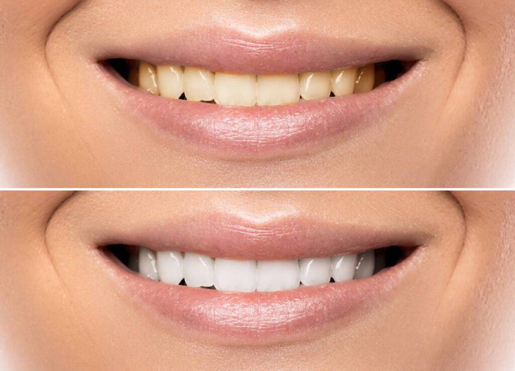 How Can You Protect Your White Smile as a Coffee Lover Crewe?