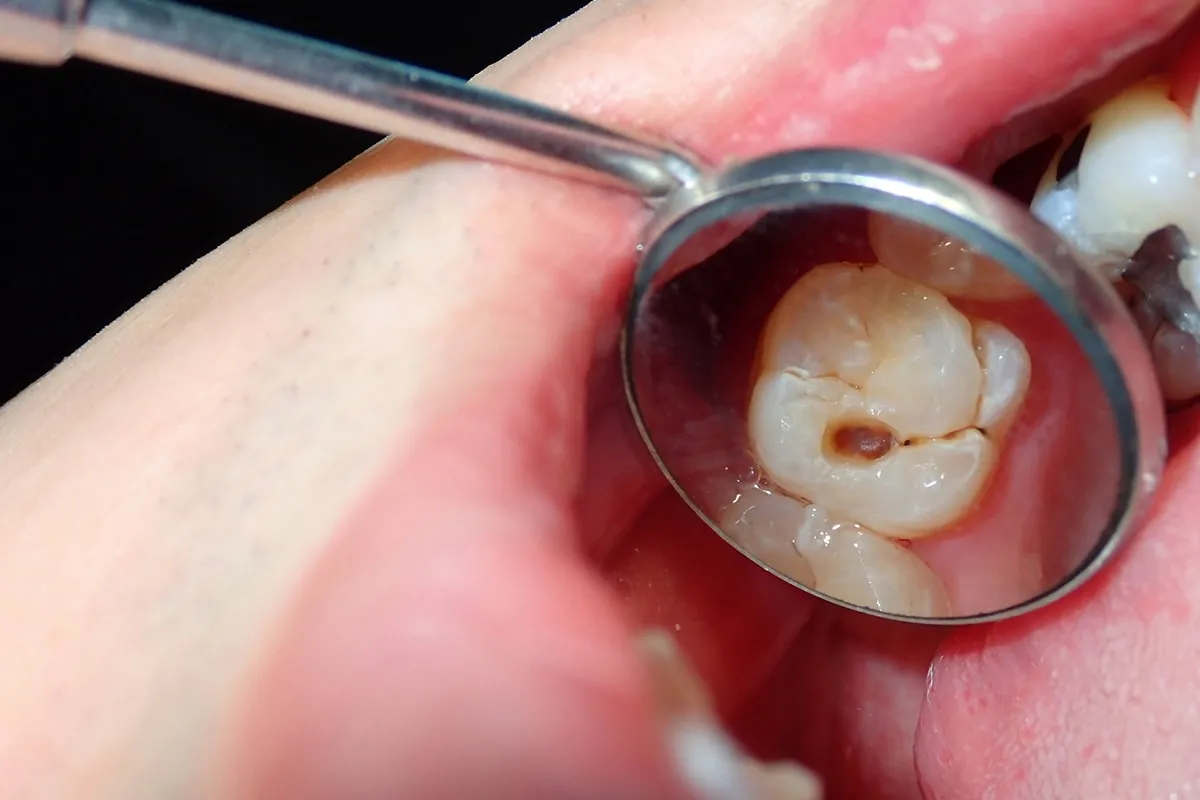Why Do Teeth Crack? Common Causes to Know Crewe