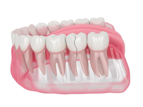 How Can You Manage Pain and Discomfort After a Root Canal Crewe?