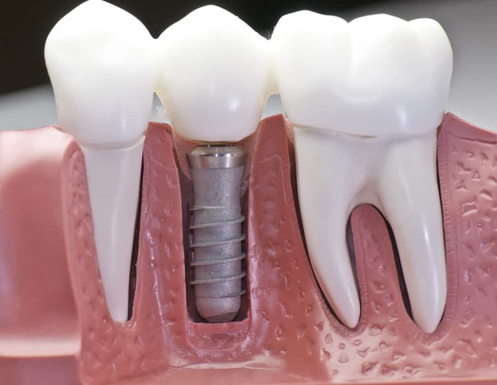 Common Misconceptions About Modern Dental Treatments Crewe
