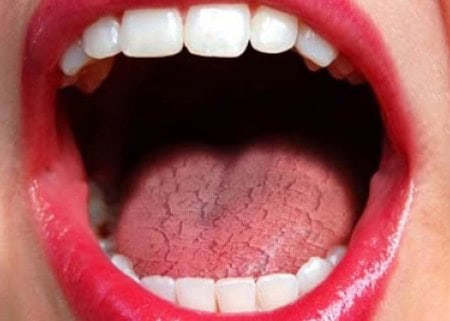 Common Causes of Dry Mouth (Xerostomia) Crewe