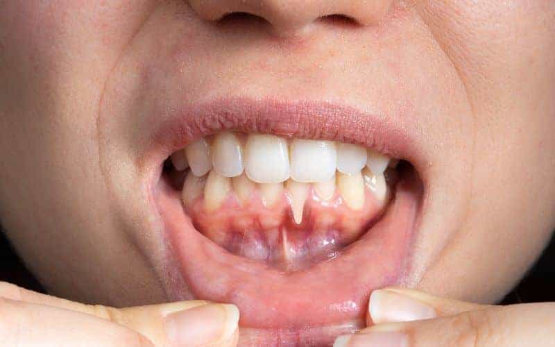 How Can Gum Disease Be Prevented Crewe?