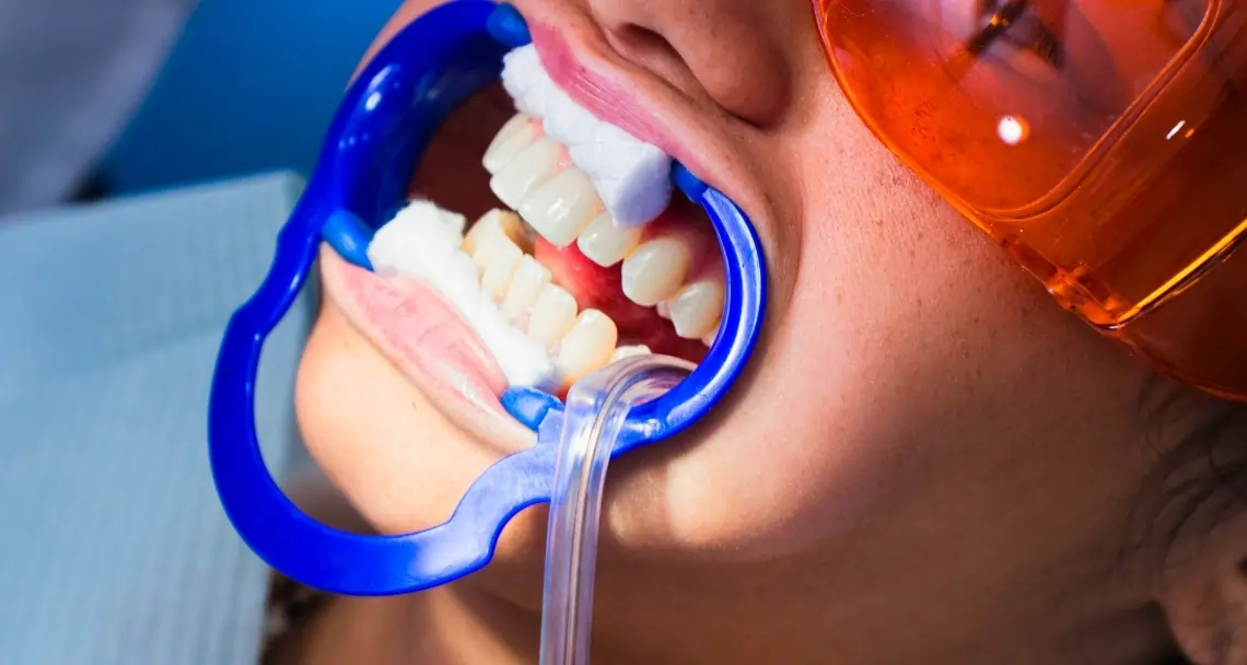 FAQs: Laser Teeth Whitening vs. At-Home Kits Crewe