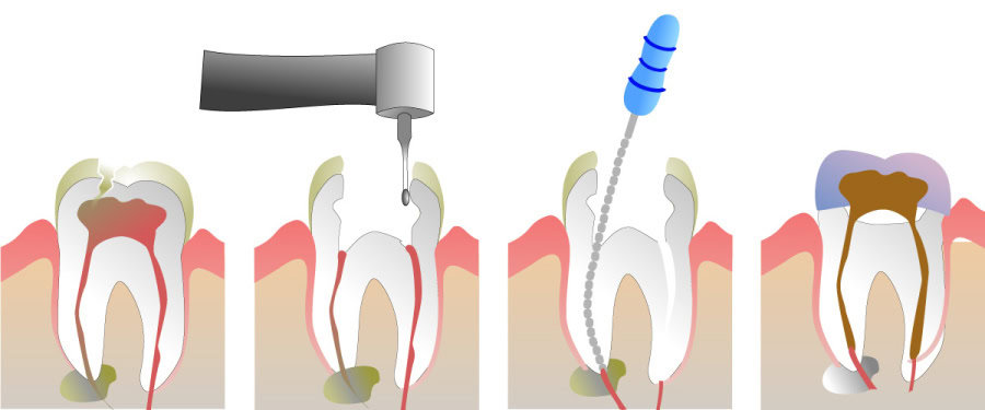 How Do You Properly Care for Your Teeth After a Root Canal Crewe