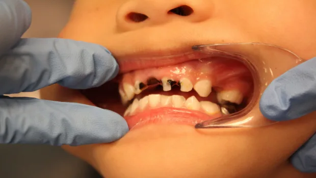 Can Your Diet Help You Achieve a Whiter, Healthier Smile Crewe?