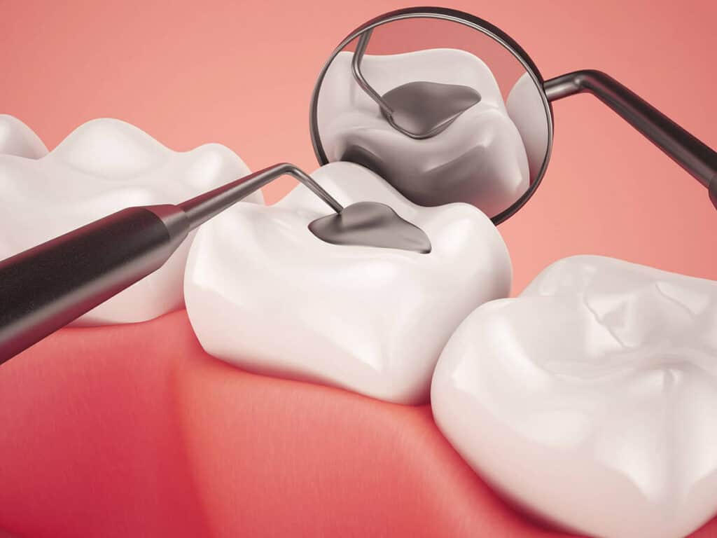 Fighting Cavities and Plaque Buildup Crewe