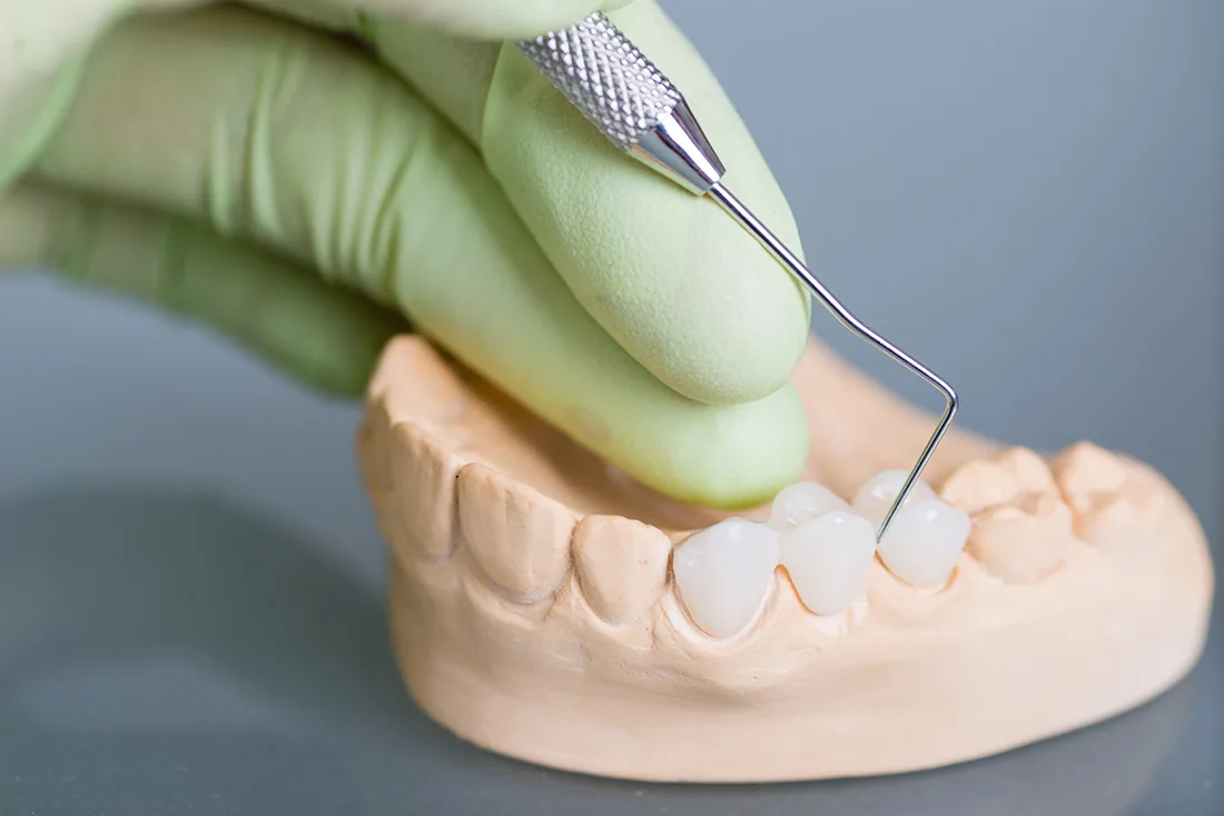 What Are the Different Types of Dental Crowns Available Crewe?
