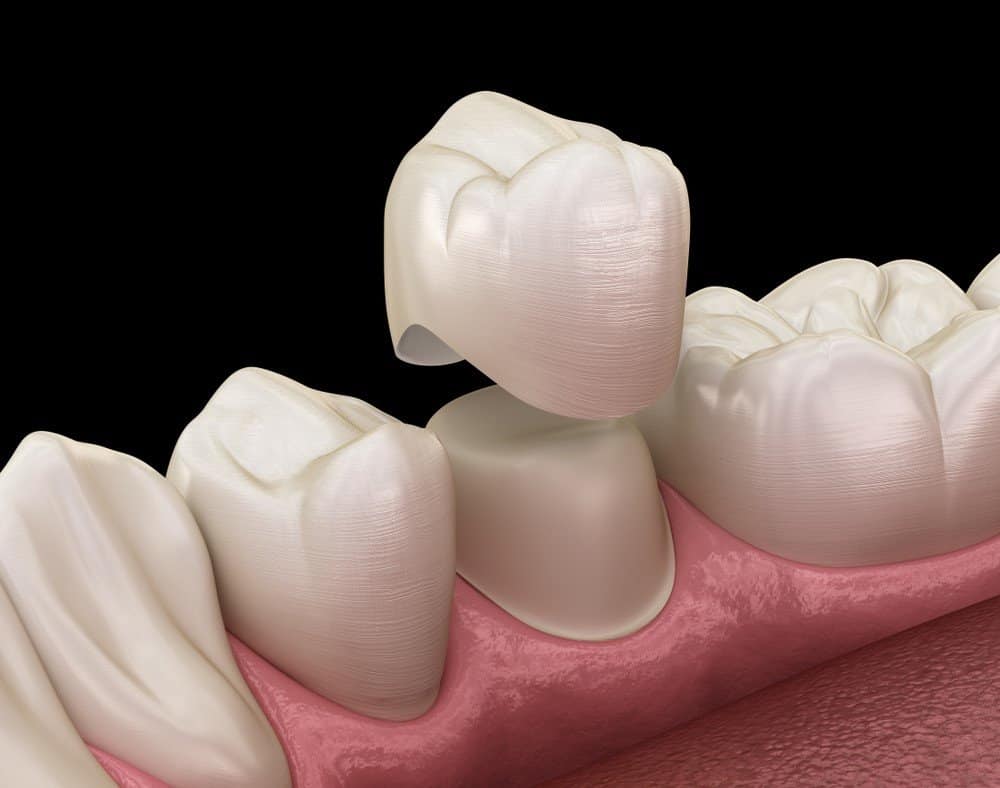 Teeth Whitening: Separating Facts from Fiction Crewe