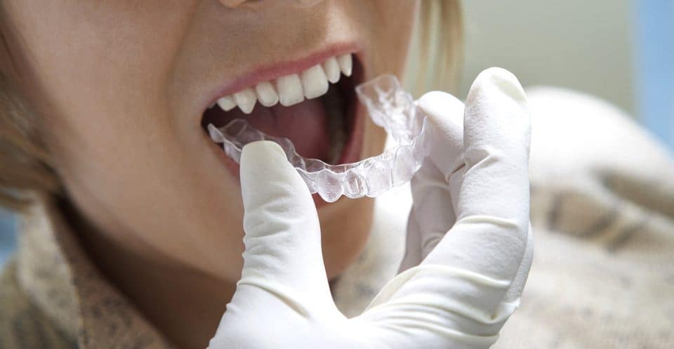 Why Bleaching Trays Require More Time Crewe